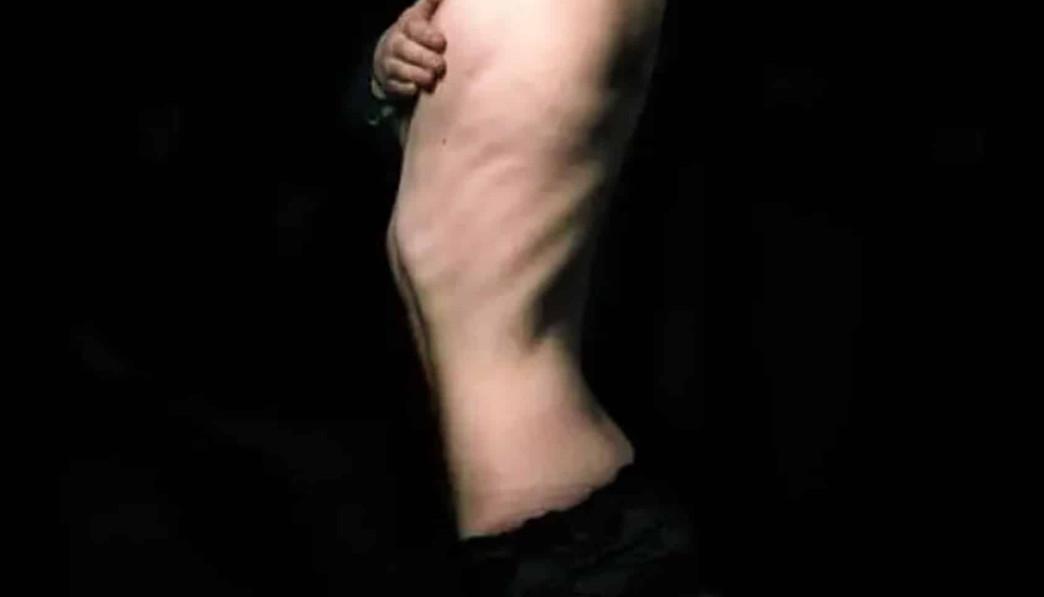ondervoeding en starvation (uithongering) bij anorexia