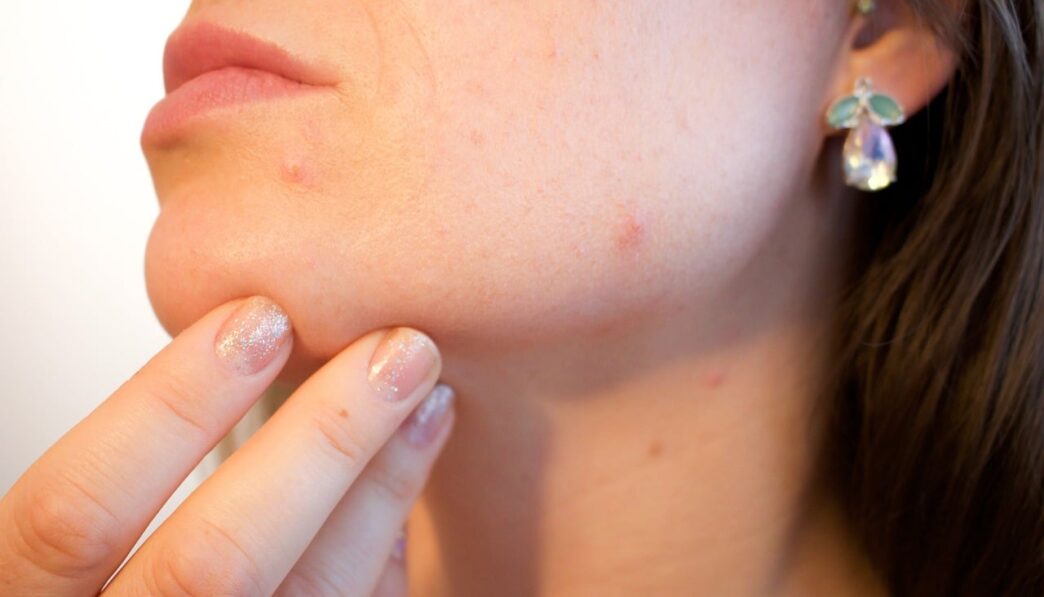vrouw met acne